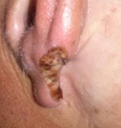 langlois ear